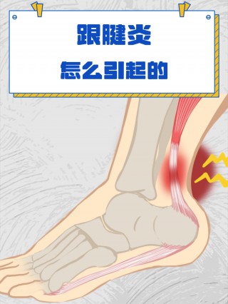 足球跟腱炎(足跟腱炎用什么药效果好)
